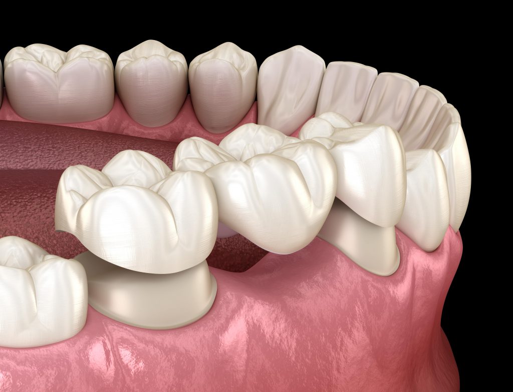 Illustration of a traditional dental bridge supported by crowns on adjacent teeth