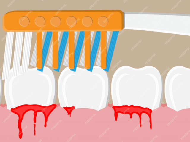 Why Do My Gums Bleed When I Brush? Here’s What It Could Mean