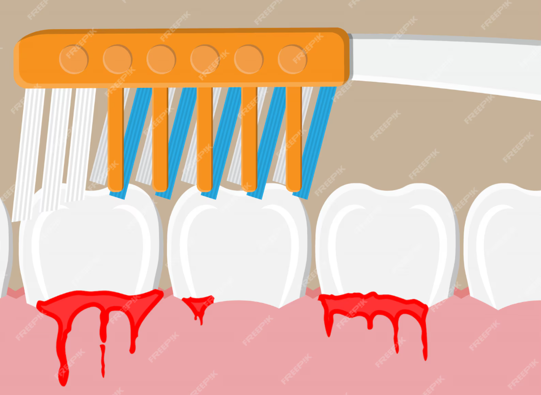 “Close-up illustration of bleeding gums and toothbrush – Pure Bliss Dental Care”