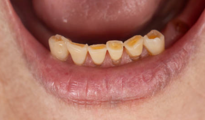 Close-up of teeth showing enamel erosion and surface wear